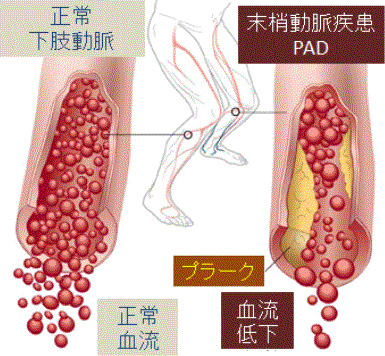 むくみ、静脈瘤、銀のすず、子宮動脈
