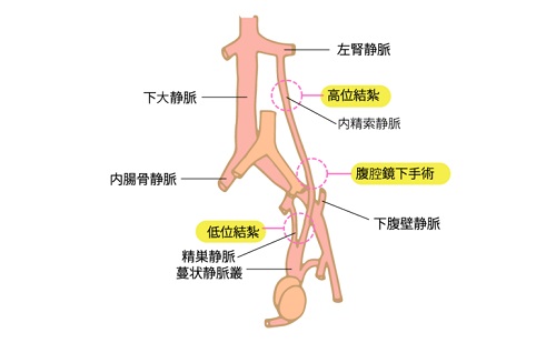 男性不妊、体質改善、精索静脈瘤