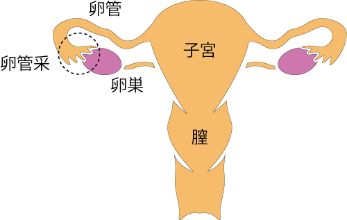 ピックアップ障害、卵管采、不妊、体外受精