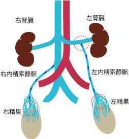 男性不妊、精子、精索静脈瘤